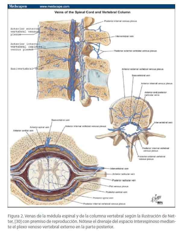 Hipertensión intracraneal venosa sinusal