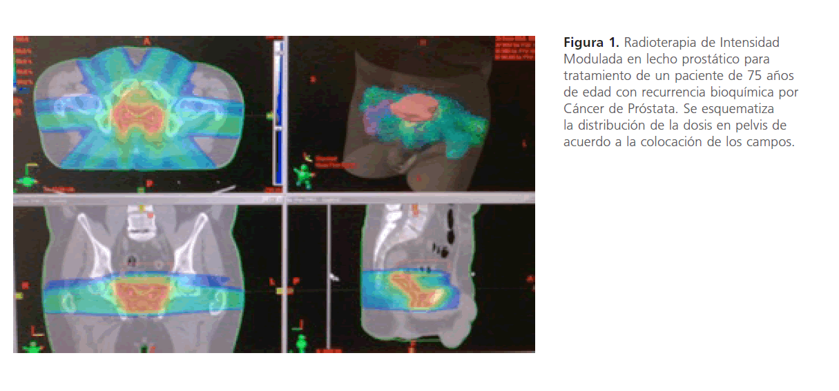 radioterapia en las recurrencias del cáncer de próstata radioterapia en las recurrencias del cáncer de próstata