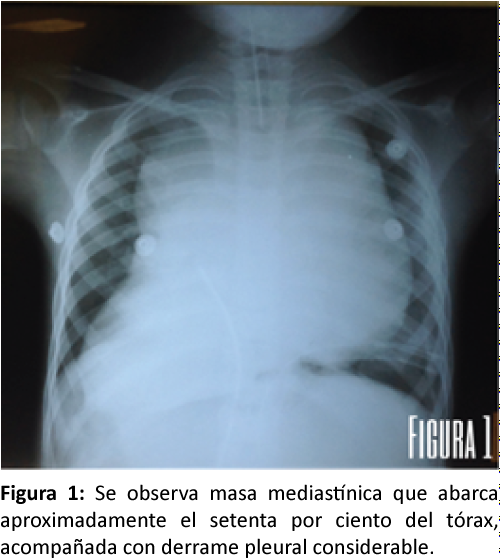 que es un linfoma maligno