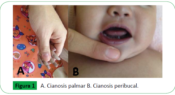 agenesia por deslizamiento pulmonar