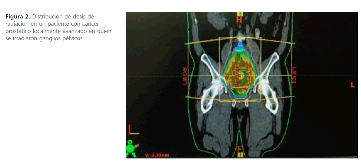 radioterapia adyuvante para el cáncer de próstata