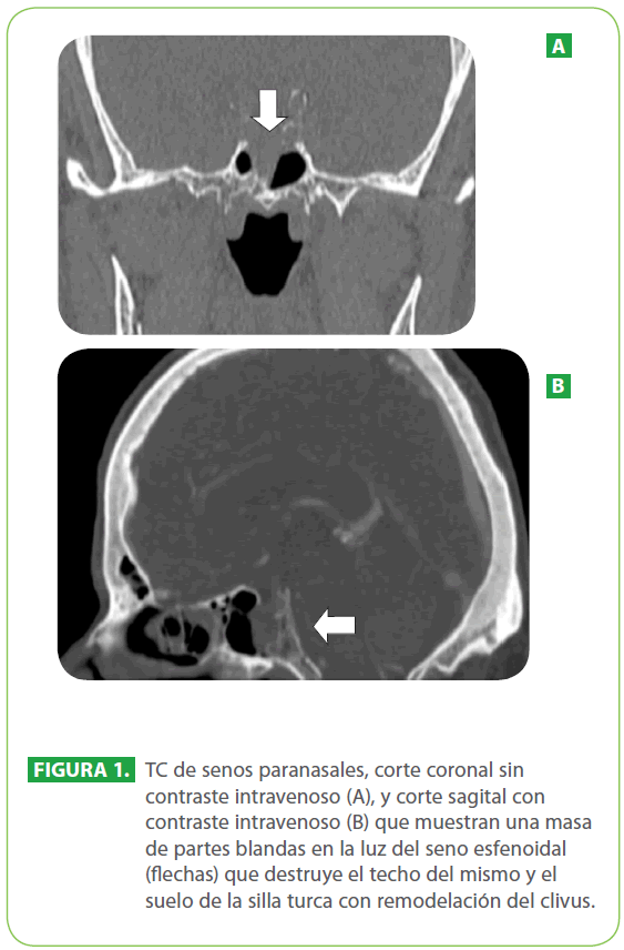 sintomas de cancer de senos nasales