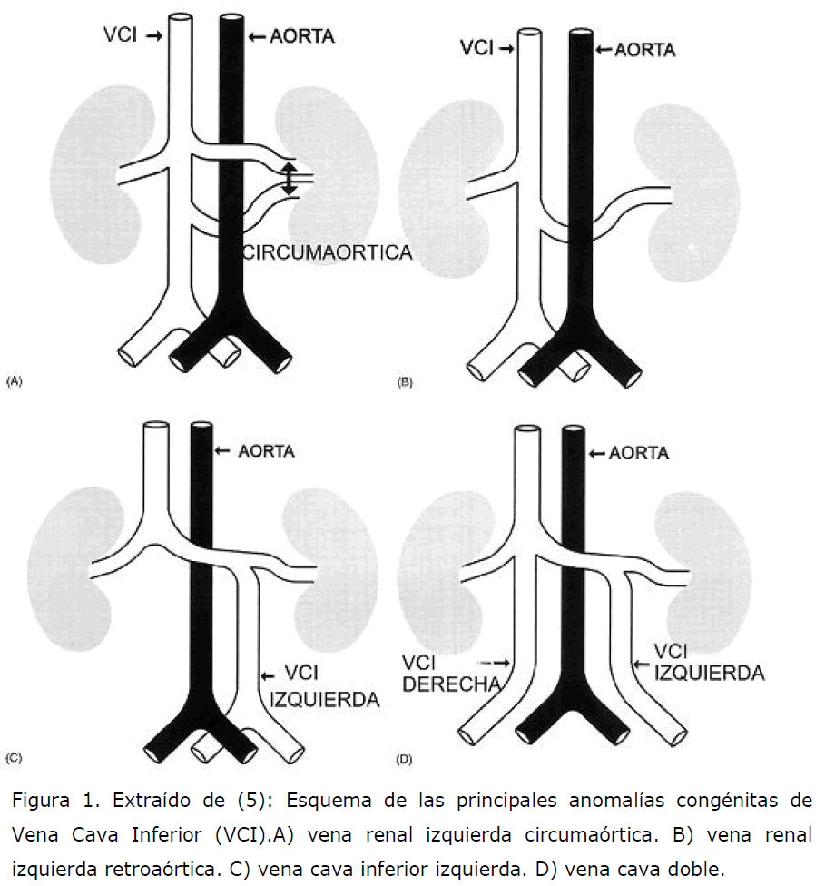 Tributaria izquierda vena